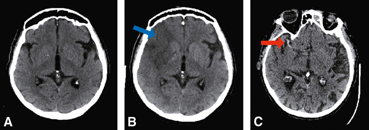 Les images IRM montrent des signes d'ischémie cérébrale précoce : hyperintensité en DWI, hypointensité en ADC, œdème en FLAIR et artefacts en T2*, essentiels pour un diagnostic rapide.