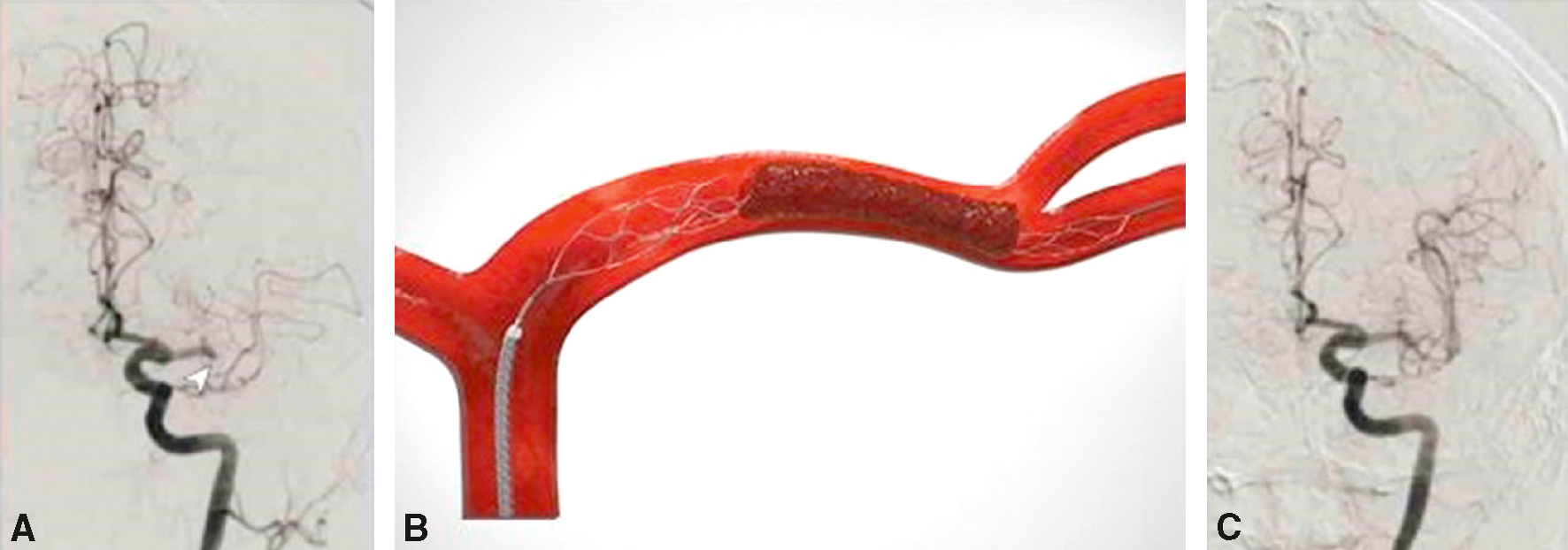 La stratégie thérapeutique de l'AVC aigu repose sur la thrombolyse IV ou antiagrégants, la thrombectomie mécanique, la gestion de la tension, et la réversion des anticoagulants.