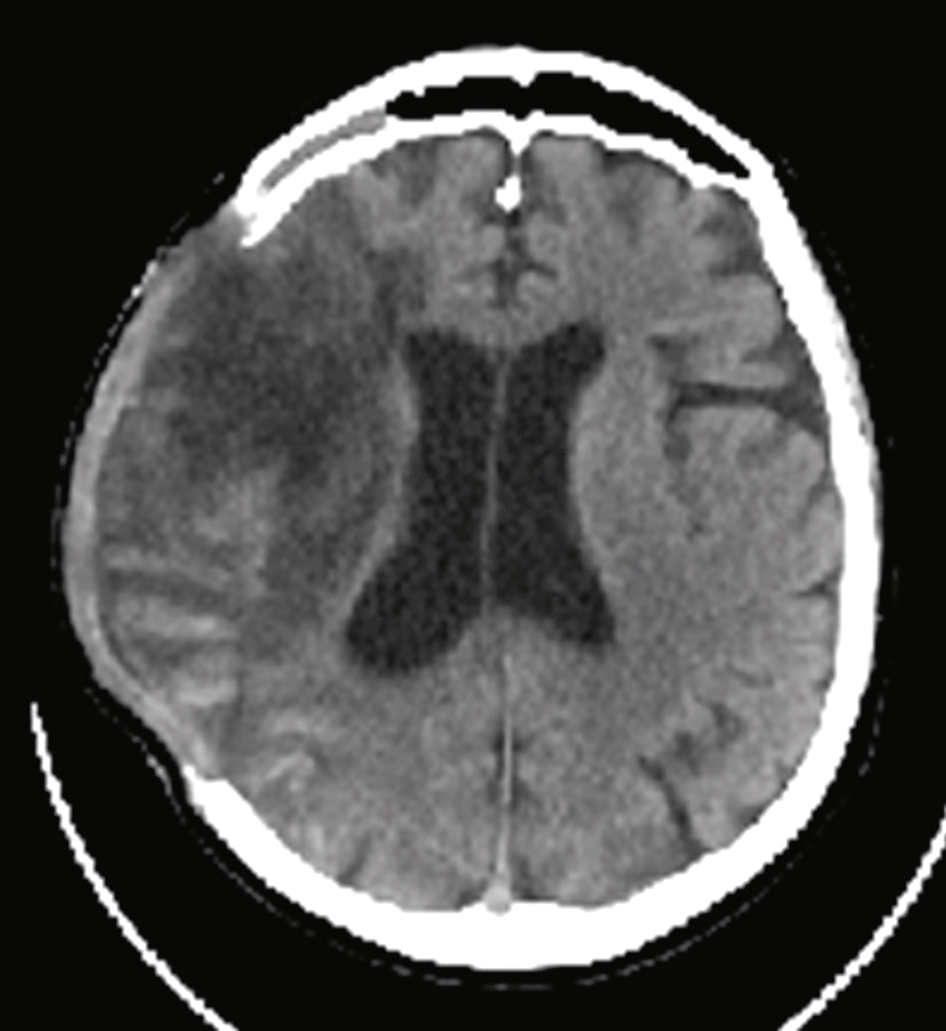 La thrombectomie mécanique est une procédure pour retirer un caillot sanguin lors d'un AVC ischémique. Elle restaure la circulation, réduisant les séquelles graves.
