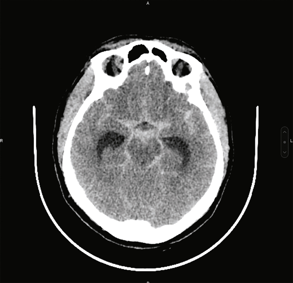 Scanner cérébral sans contraste montrant une hyperdensité méningée dans les citernes de la base et vallées sylviennes, évocatrice d’hémorragie aiguë.