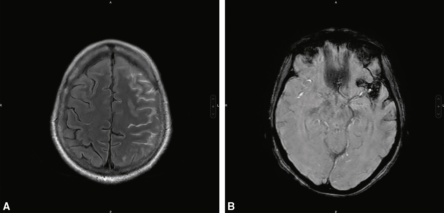 IRM FLAIR et SWI montrant une HSA corticale frontale gauche avec dépôts hématiques visibles dans la vallée sylvienne, évocateurs d’une origine non anévrismale.