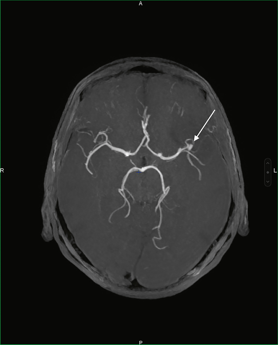 Angiographie en IRM révélant un anévrisme de l’artère cérébrale moyenne gauche visible à la bifurcation.