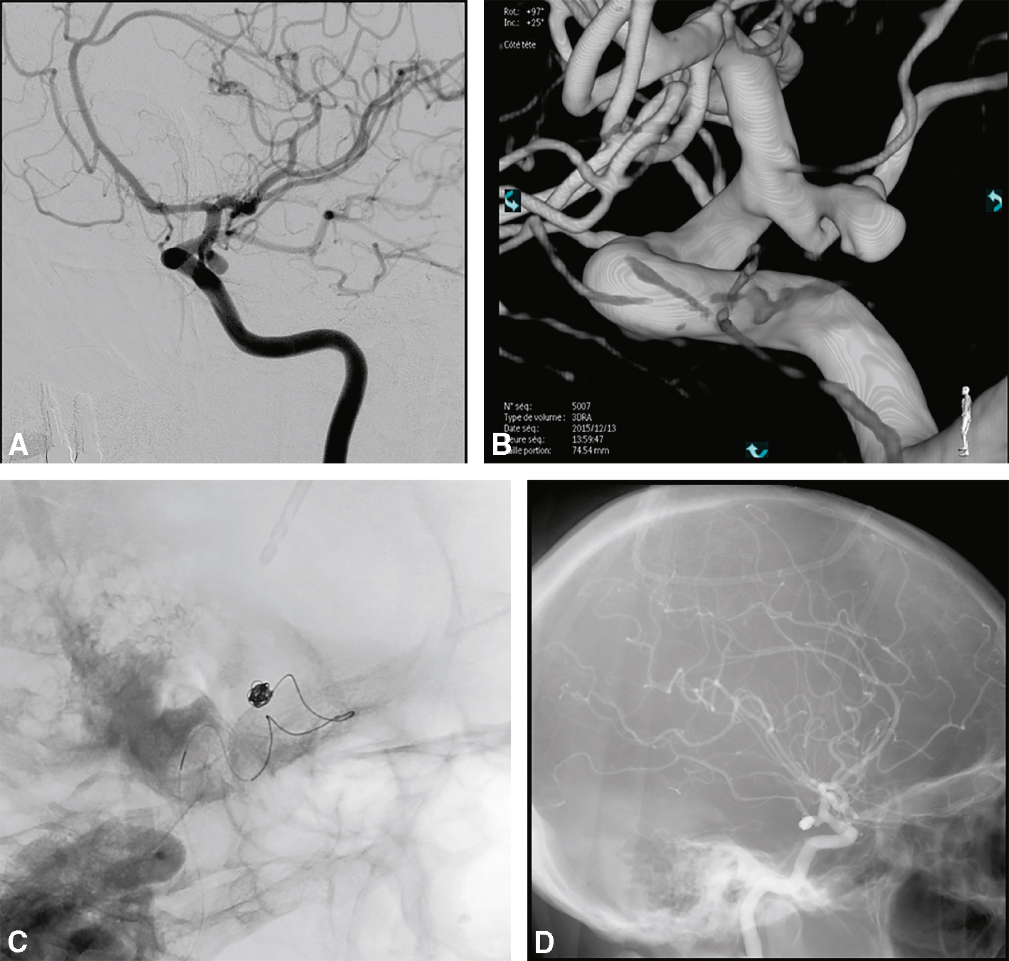 Série illustrant l’embolisation endovasculaire d’un anévrisme de la communicante postérieure gauche, depuis sa détection jusqu’à son exclusion complète.