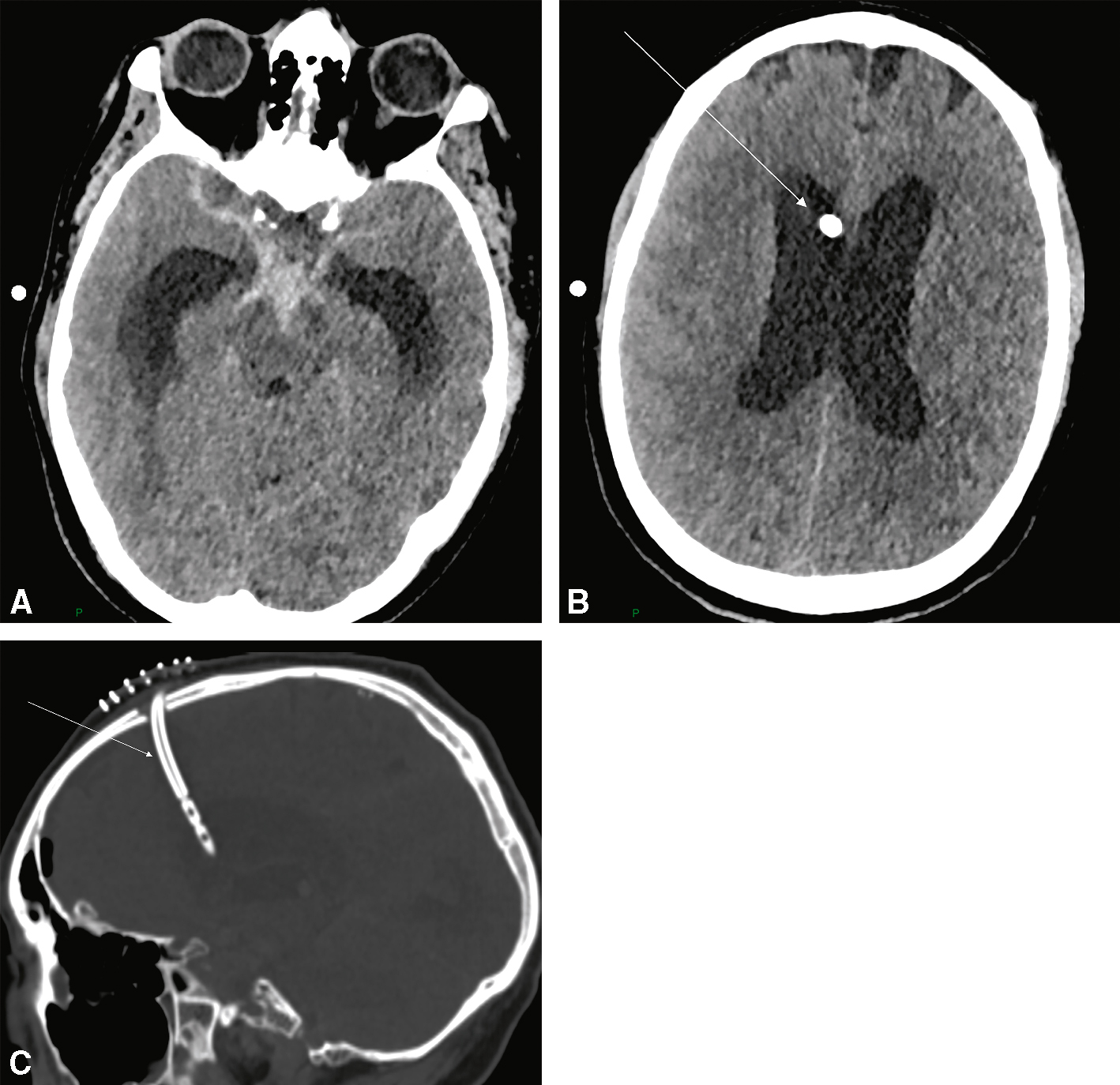 Scanner montrant un cathéter de DVE bien positionné dans le ventricule droit, en contexte d’hydrocéphalie sans signe de complication visible.