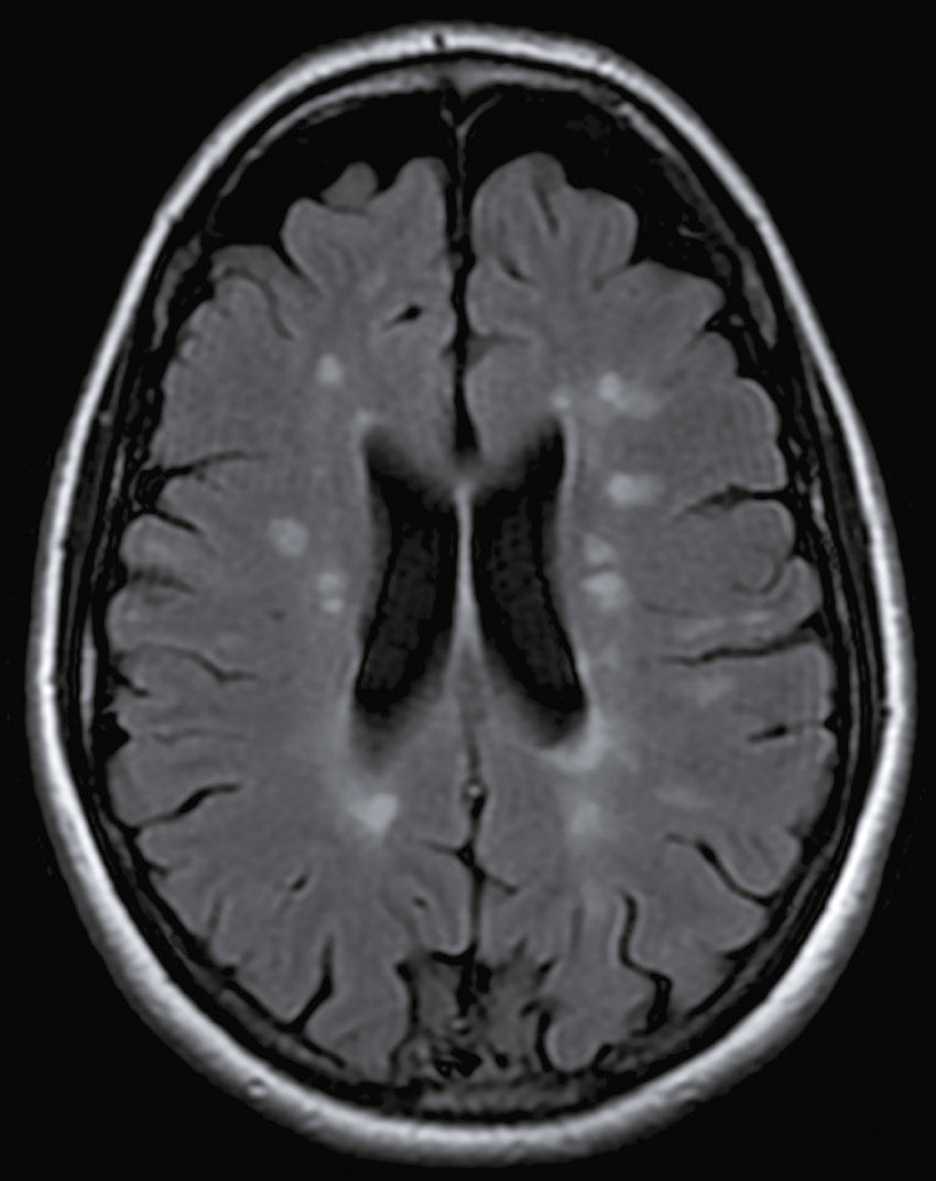 IRM cérébrale axiale : montre matière grise et blanche, ventricules et anomalies possibles. Cruciale pour diagnostiquer des maladies neurologiques comme la sclérose en plaques.