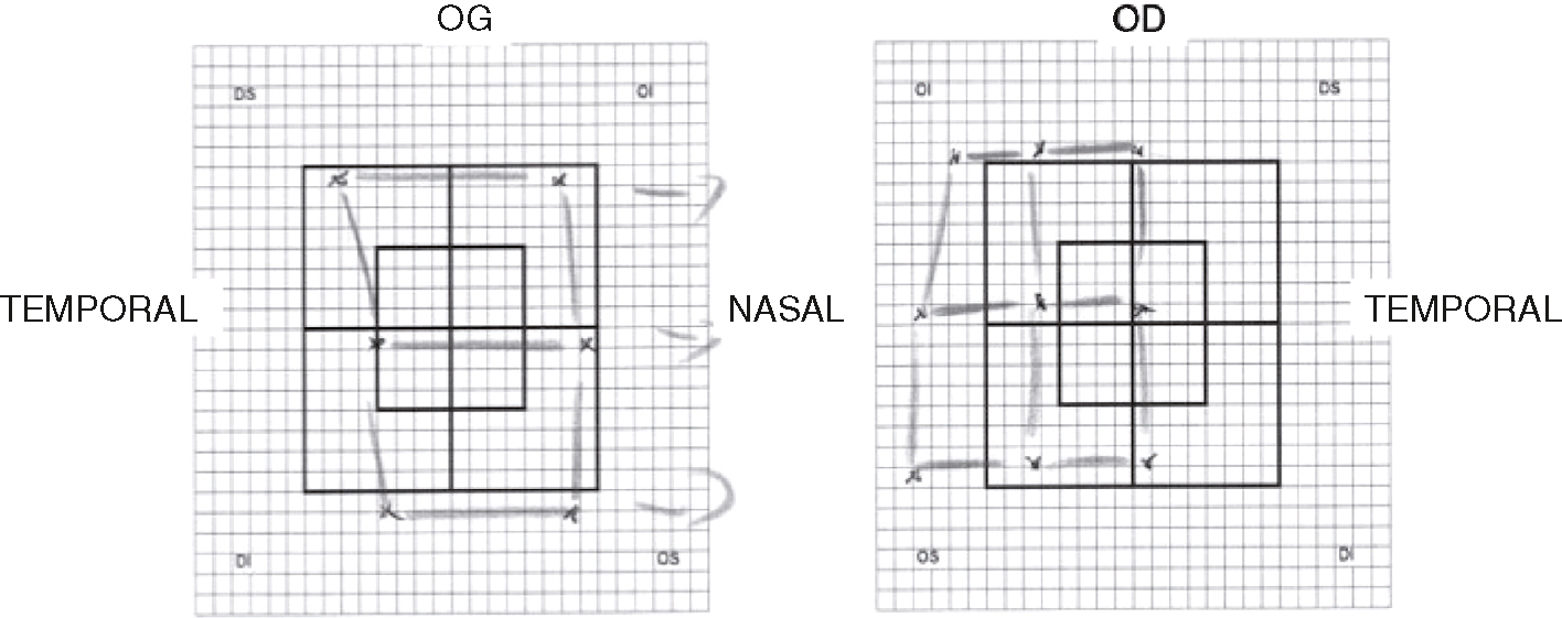 Diagrammes du champ visuel : OG et OD, montrant zones temporelles et nasales. Crucial pour diagnostiquer la perte de vision et évaluer les pathologies oculaires.