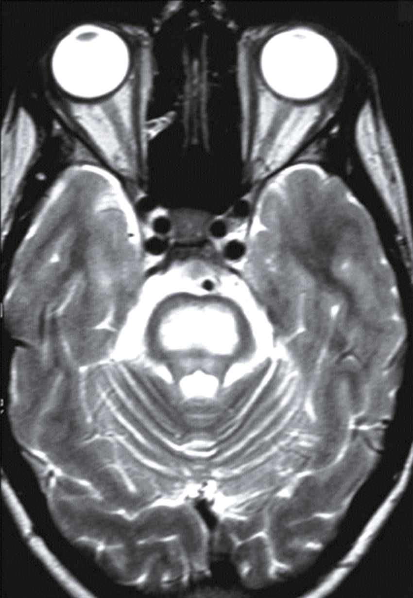 Cette IRM cérébrale en coupe axiale montre le cerveau avec des détails précis. Elle permet d'évaluer des pathologies neurologiques, offrant une vue claire des structures internes essentielles.