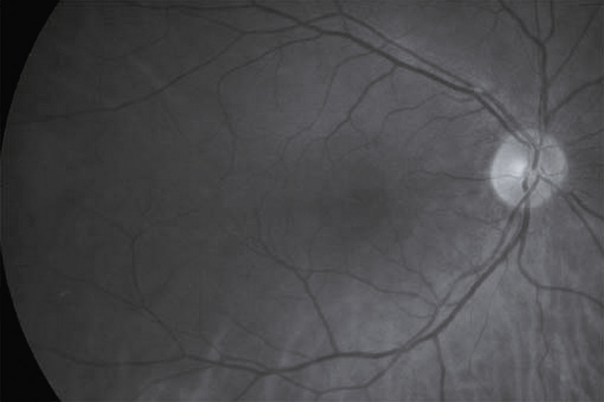 L'image montre la rétine humaine avec des vaisseaux sanguins ramifiés et le disque optique. Elle est utilisée pour diagnostiquer des anomalies oculaires comme la rétinopathie.