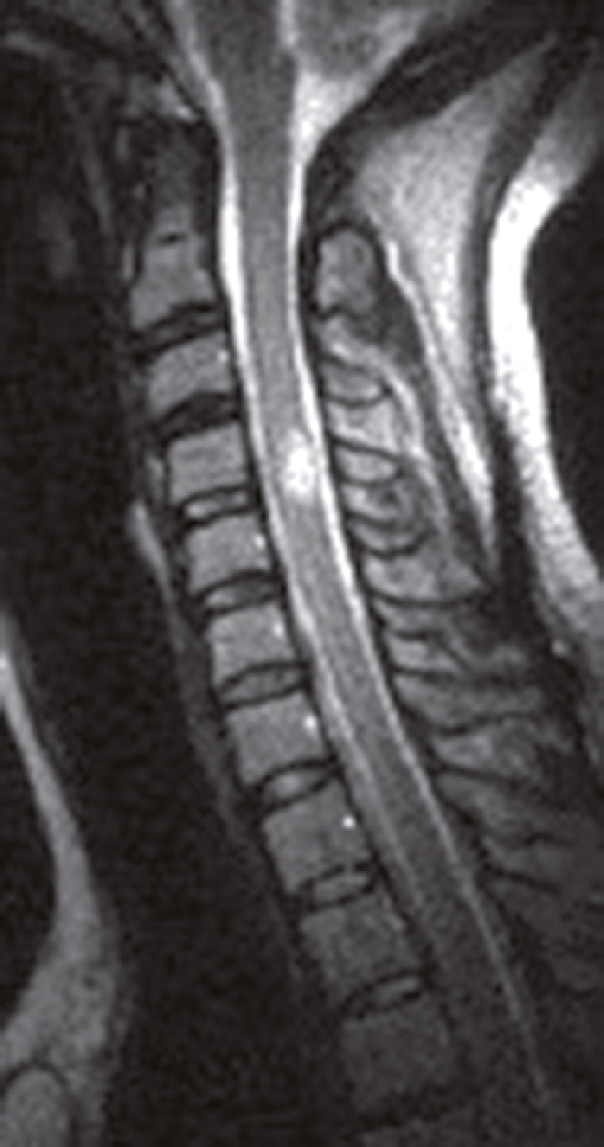 L'image montre une IRM de la colonne cervicale, avec les vertèbres, la moelle épinière et les disques intervertébraux visibles. Elle sert à détecter des anomalies comme des hernies.