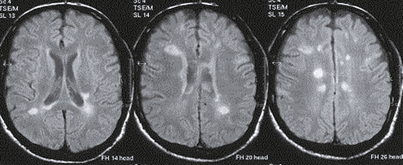 L'image montre trois IRM du cerveau humain, avec des zones hyperintenses indiquant des anomalies. Ces coupes permettent d'évaluer les pathologies cérébrales et d'ajuster les traitements.