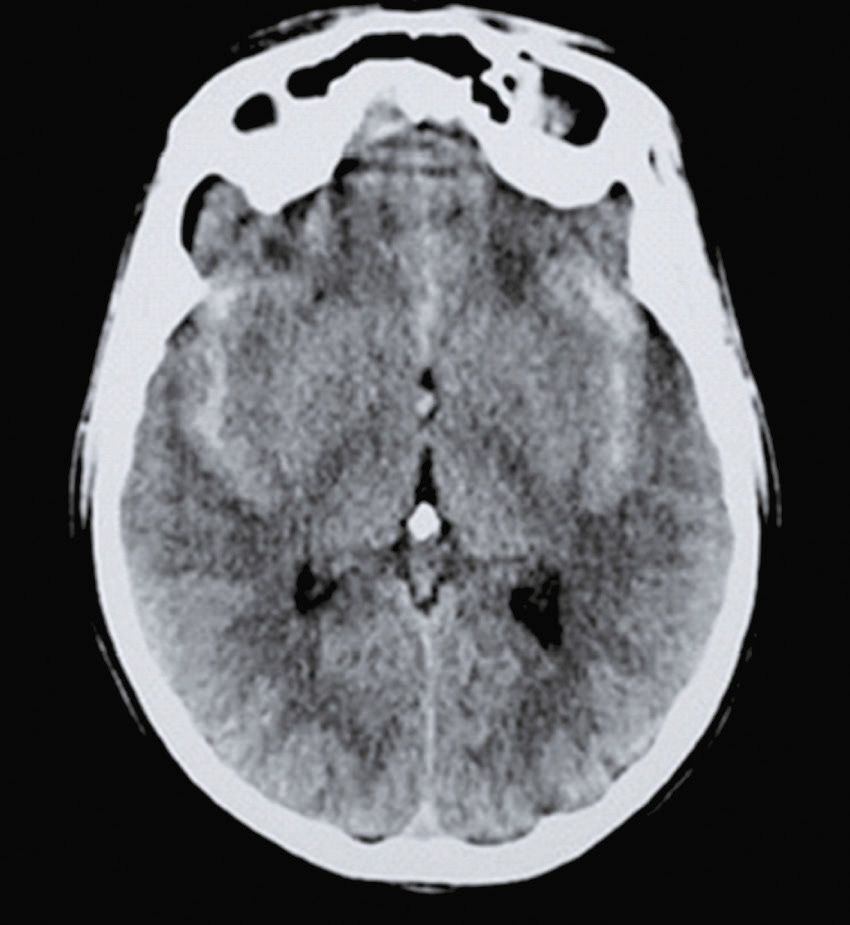 L'image montre une coupe transversale d'un scanner cérébral, mettant en évidence les structures du cerveau et du crâne. Les variations de gris aident à détecter des anomalies.
