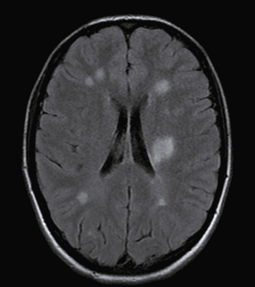 L'image montre une coupe IRM du cerveau humain, avec des zones claires indiquant des anomalies, et des zones sombres représentant les ventricules cérébraux.