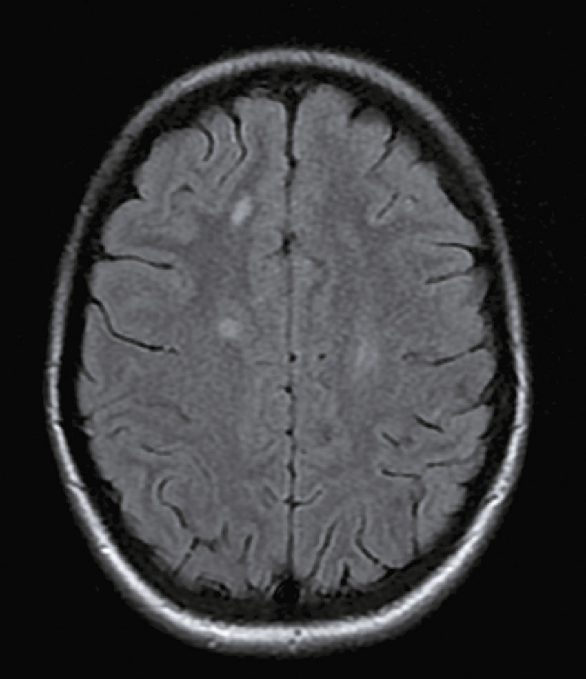 L'image montre une coupe IRM du cerveau humain, détaillant les structures internes. Les zones claires indiquent des anomalies, tandis que les sombres montrent les ventricules.
