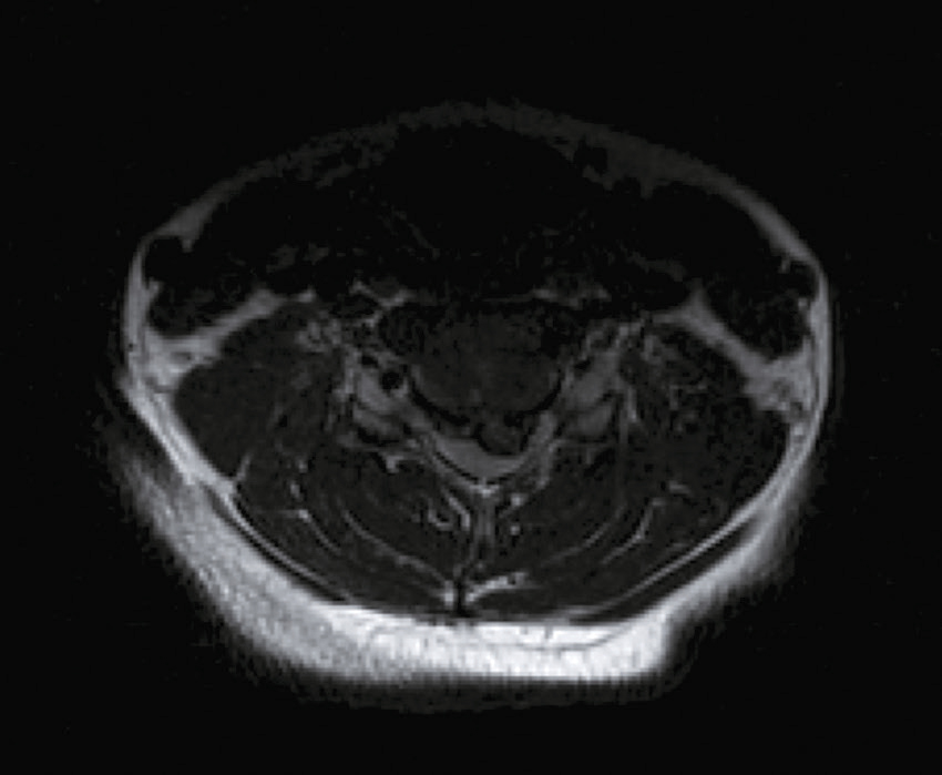 Image IRM montrant une coupe transversale cervicale : moelle épinière centrale, muscles autour et vertèbres visibles en cercle, utile pour visualiser tissus et structures.