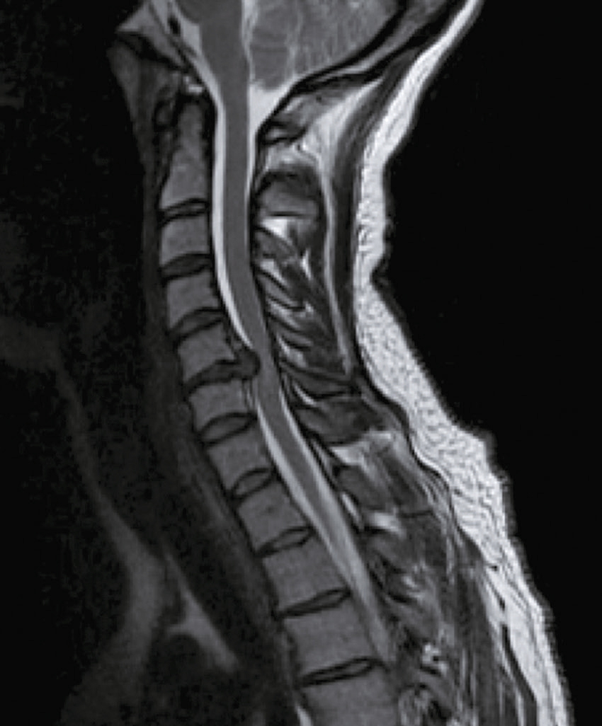 IRM de la colonne cervicale montrant les vertèbres, disques intervertébraux, moelle épinière et liquide céphalo-rachidien, utile pour diagnostiquer des anomalies.