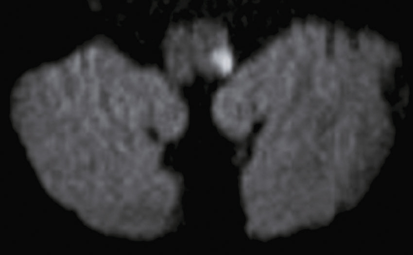 IRM du cerveau montrant une zone hyperintense, pouvant indiquer une anomalie, et les deux hémisphères cérébraux, utilisée pour diagnostiquer des conditions neurologiques.