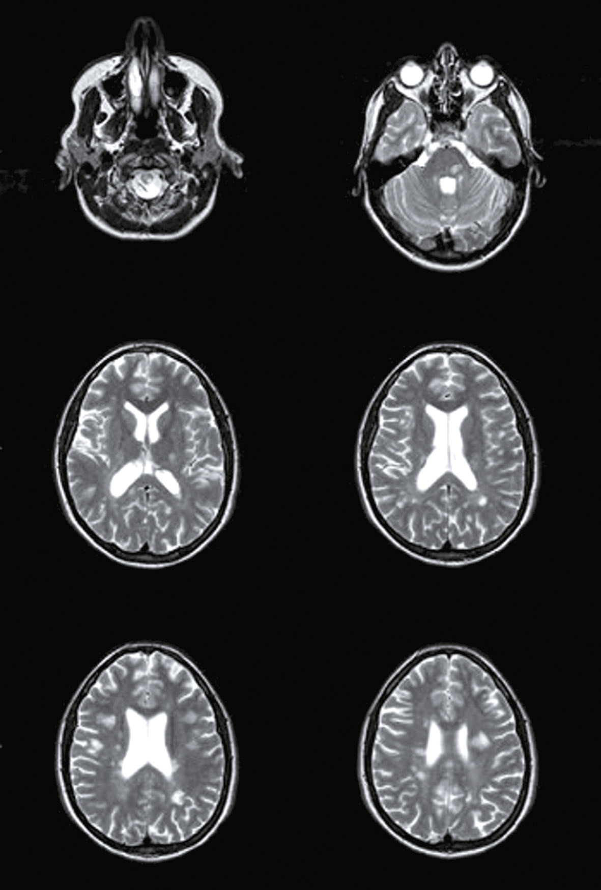 IRM du cerveau montrant des coupes transversales à différents niveaux, mettant en évidence la substance blanche et grise, les ventricules et des anomalies possibles.