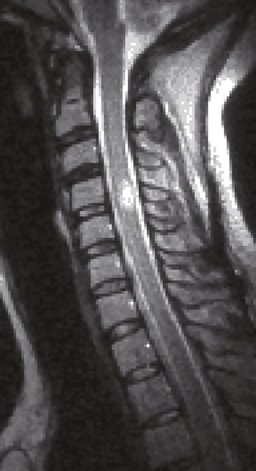 IRM de la colonne cervicale montrant les vertèbres, les disques intervertébraux et la moelle épinière, utile pour diagnostiquer des hernies discales et autres anomalies.