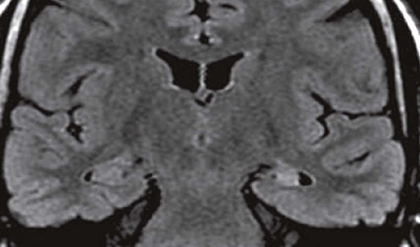 IRM cérébrale en coupe coronale montrant les ventricules, la matière grise et blanche, utilisée pour détecter des anomalies cérébrales et planifier les traitements nécessaires.