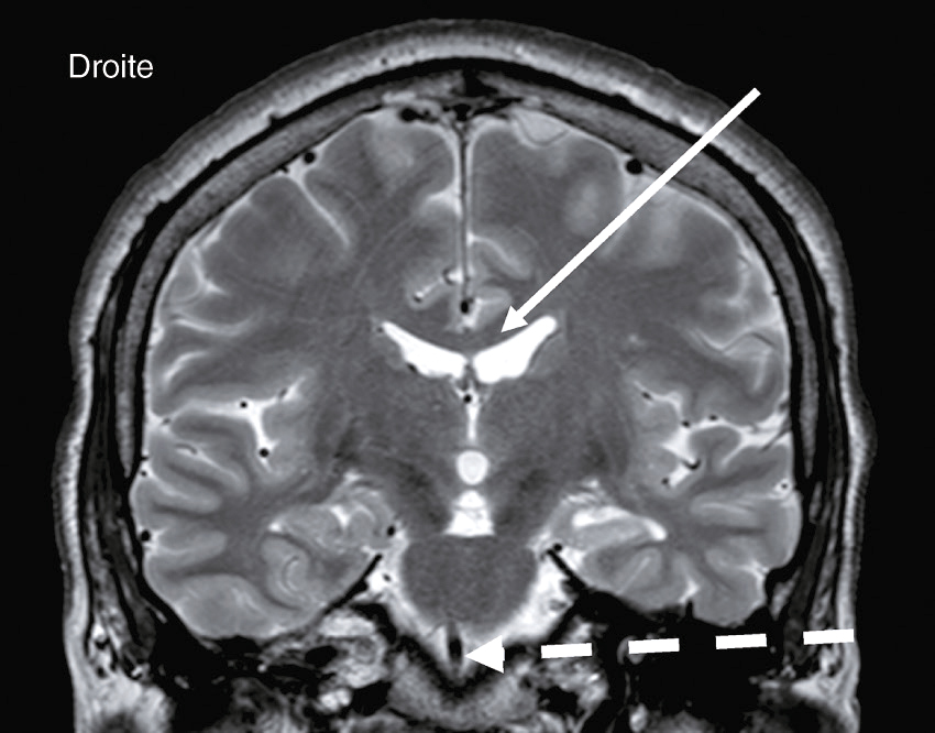 IRM cérébrale en coupe coronale montrant les ventricules, avec une flèche indiquant une zone d'intérêt, utilisée pour diagnostiquer et suivre l'évolution des pathologies neurologiques.