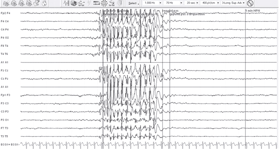 Vue rapprochée de deux yeux humains en noir et blanc, mettant en évidence les pupilles, l'iris, la sclère et les cils, utilisée pour évaluer la santé oculaire et détecter des anomalies.