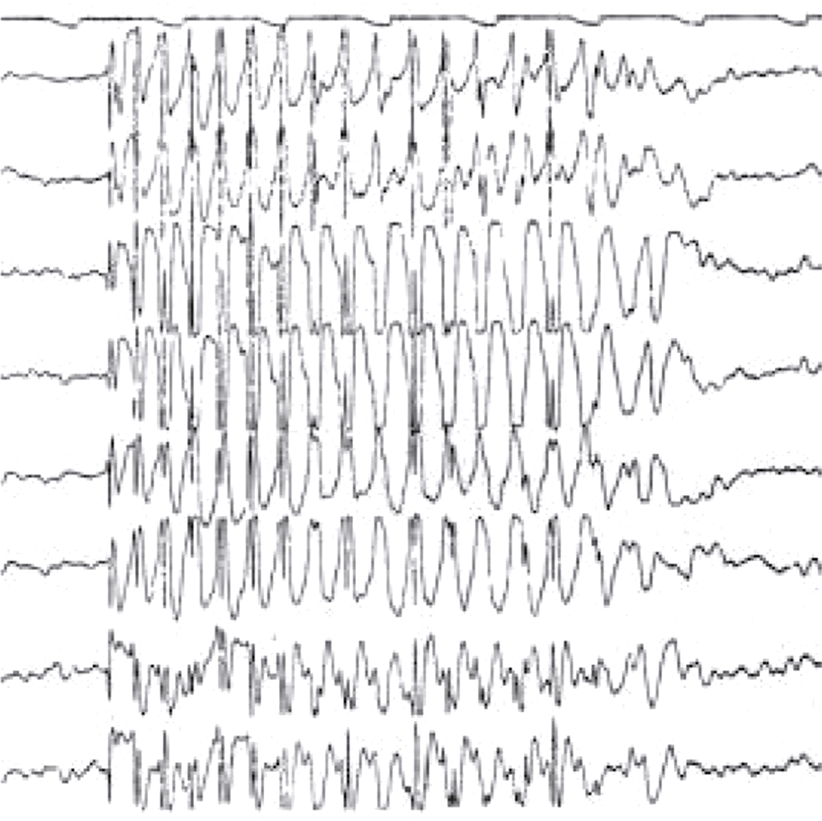 Vue rapprochée des yeux humains montrant l'iris, la pupille, la sclère et les vaisseaux sanguins, utile pour comprendre les structures anatomiques de l'œil et leur rôle dans la vision.