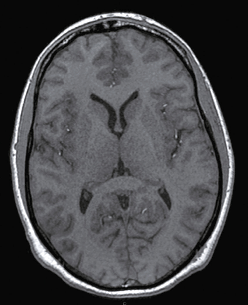 IRM du cerveau en coupe transversale montrant les ventricules latéraux et les tissus cérébraux, utilisée pour diagnostiquer et suivre les conditions neurologiques.