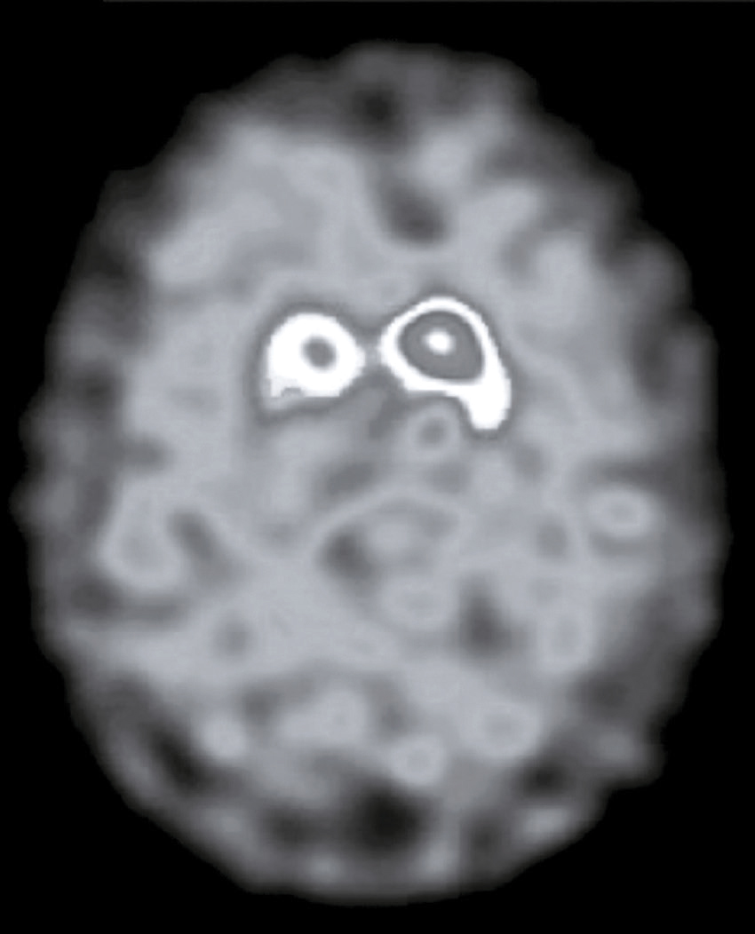 Image médicale TEP montrant l'activité cérébrale via un traceur radioactif : zones claires indiquant une activité élevée, utile pour cartographier les fonctions neuronales.