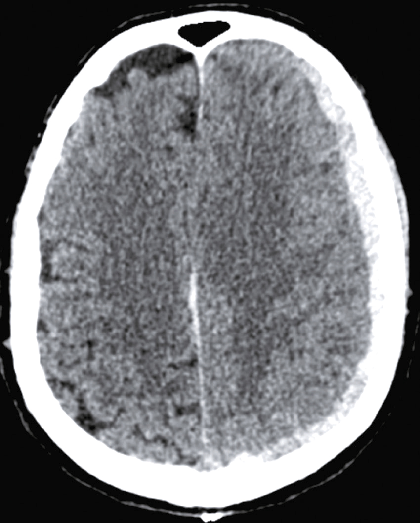 Scanner cérébral en coupe transversale montrant la matière grise, la matière blanche, les ventricules et les os du crâne, utilisé pour diagnostiquer des anomalies neurologiques.