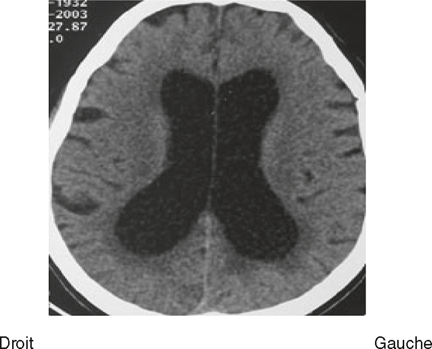 Scanner cérébral en coupe transversale montrant les ventricules latéraux, le tissu cérébral, et les os du crâne, utilisé pour diagnostiquer des pathologies neurologiques.