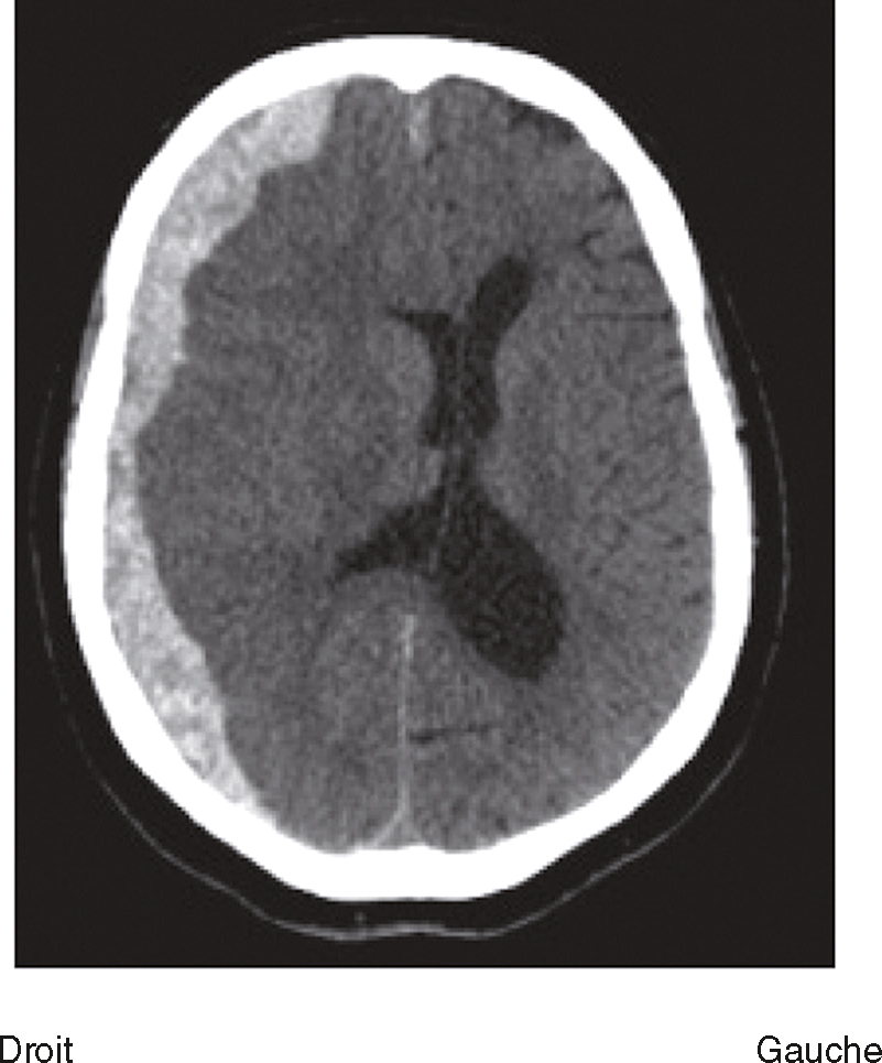 Scanner cérébral en coupe transversale montrant les ventricules, les tissus cérébraux et les os du crâne, utilisé pour diagnostiquer des anomalies neurologiques.