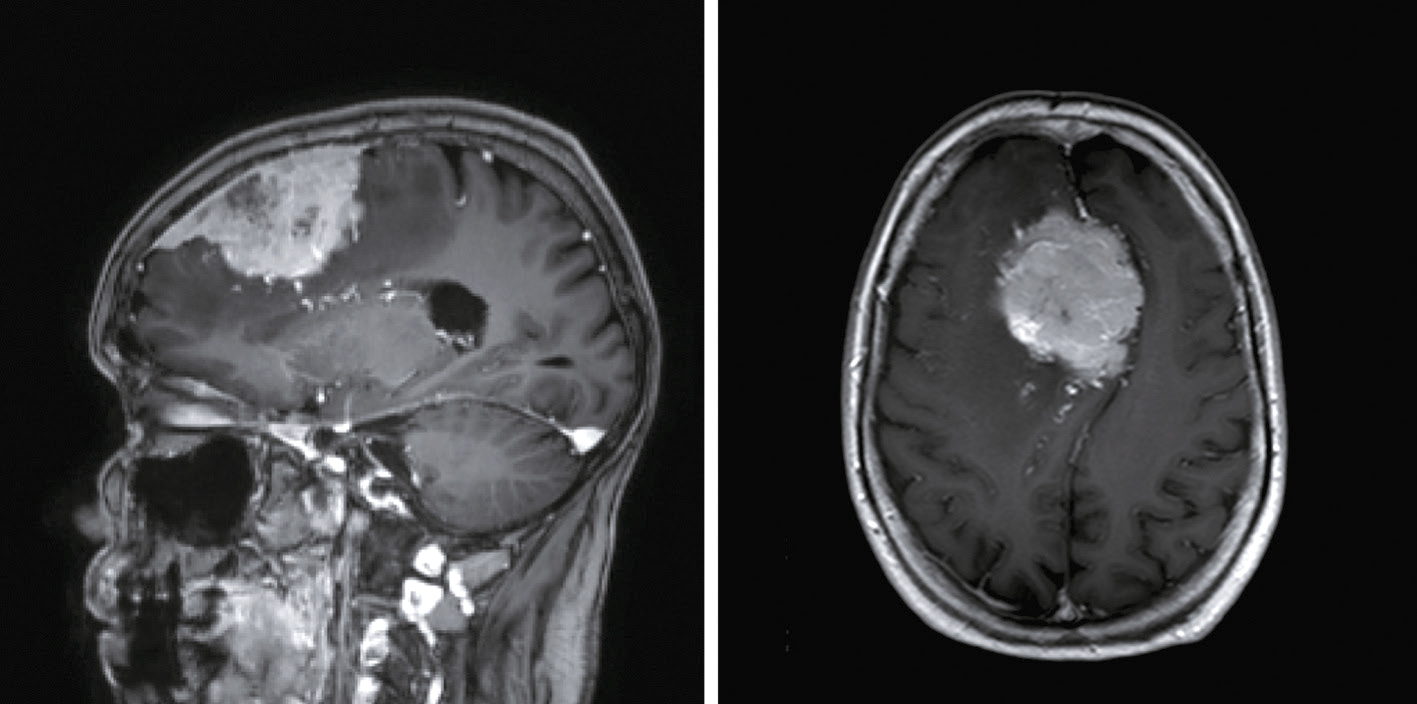 Deux scans IRM cérébraux : vue sagittale à gauche montrant une masse anormale, vue axiale à droite révélant une lésion circulaire. Ces images aident au diagnostic des anomalies cérébrales.