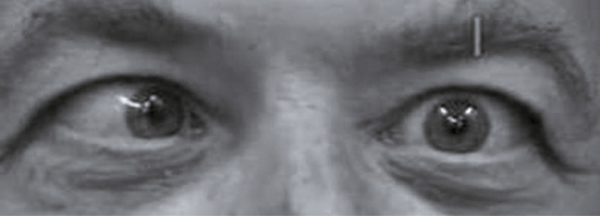 Photographie rapprochée des yeux capturant iris, cils, reflets lumineux sur la cornée et expressions naturelles, utile pour analyser l'alignement et la symétrie oculaire.