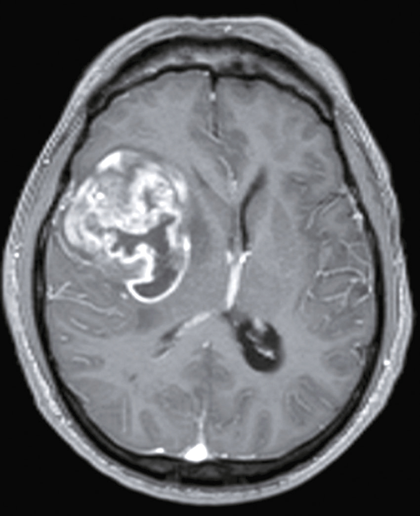 L'image montre une IRM axiale du cerveau avec une masse anormale dans l'hémisphère gauche, indiquant une lésion ou tumeur, exerçant une pression sur les structures cérébrales.