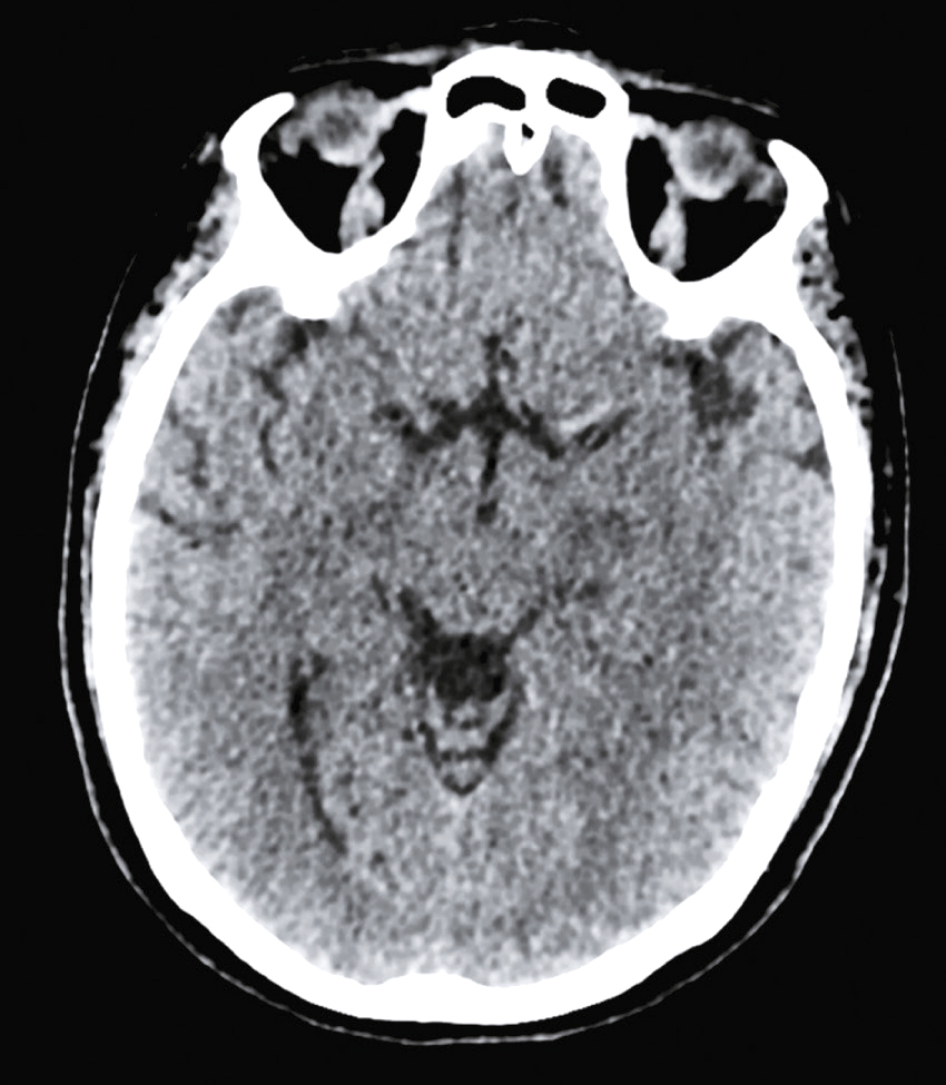 L'image montre une coupe transversale du cerveau par scanner, avec des ventricules sombres, des tissus cérébraux de différentes densités et les os du crâne en blanc.