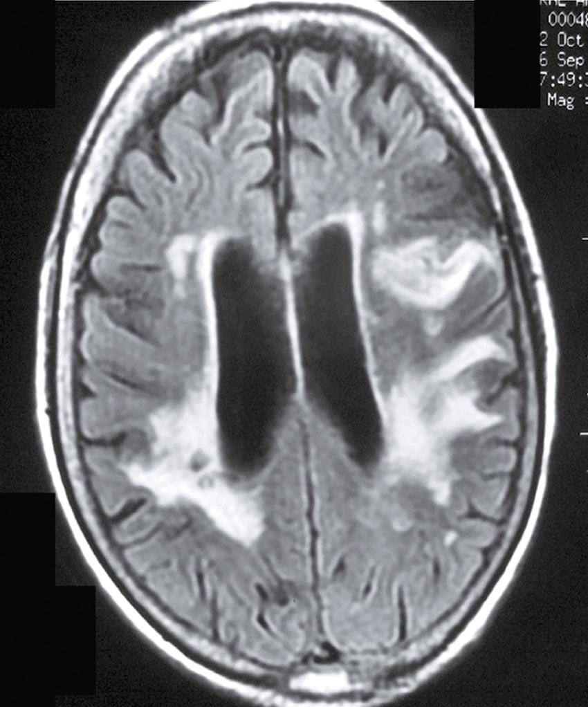 L'image montre une coupe transversale du cerveau par IRM, avec des ventricules latéraux sombres et des zones blanches indiquant des anomalies de la substance blanche.