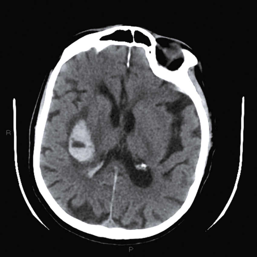 L'image montre une coupe transversale d'un scanner cérébral, révélant une hémorragie intracérébrale à gauche, près des ventricules. Cela aide à évaluer la gravité de la condition.
