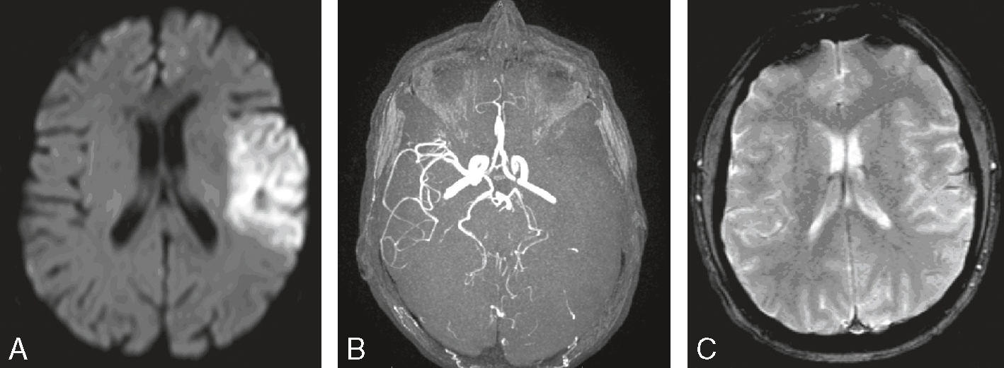 L'image montre trois scans cérébraux : A (IRM de diffusion, détecte un AVC ischémique), B (ARM, visualisation des vaisseaux sanguins), et C (IRM T2, confirme la lésion).