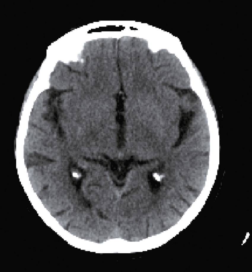L'image montre une IRM cérébrale axiale avec des ventricules latéraux sombres remplis de LCR. La matière grise et blanche est bien distincte, utile pour détecter anomalies et pathologies.