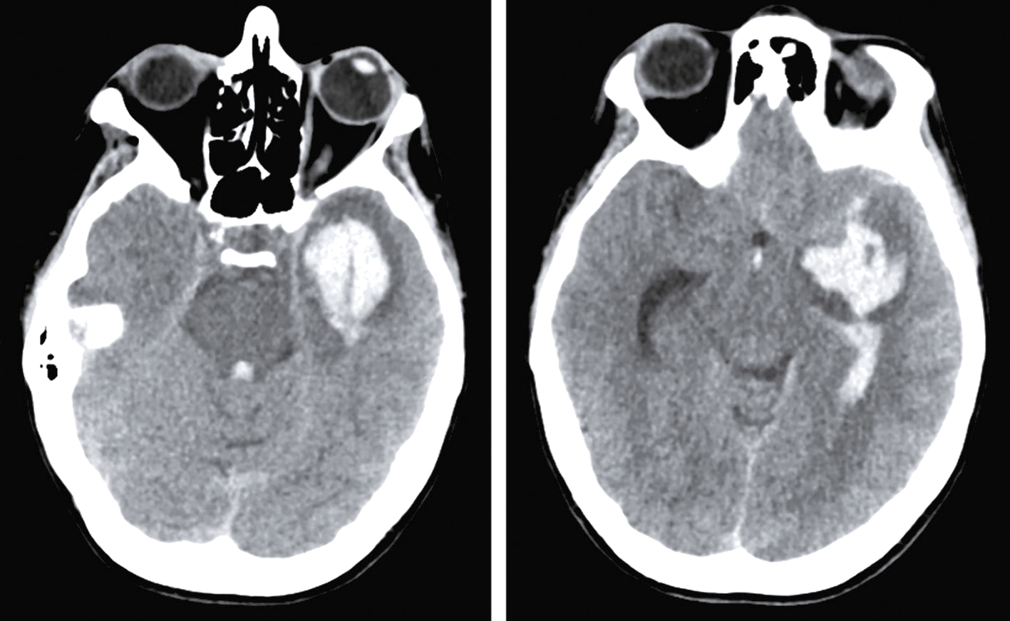 L'image montre un scanner cérébral révélant matière grise (foncée), matière blanche (claire) et ventricules (zones sombres). Utilisé pour diagnostiquer anomalies et pathologies.