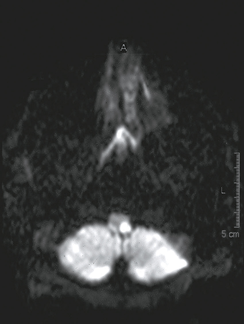 Image IRM montrant une coupe anatomique avec zones claires et sombres, révélant structures cérébrales ou nerveuses, utile pour analyser anomalies ou tissus internes.