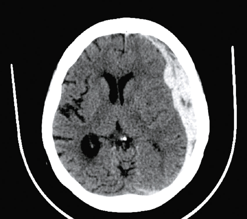 L'image montre un scanner cérébral révélant matière grise, matière blanche et ventricules sombres. Utilisée pour détecter tumeurs, hémorragies ou autres anomalies.