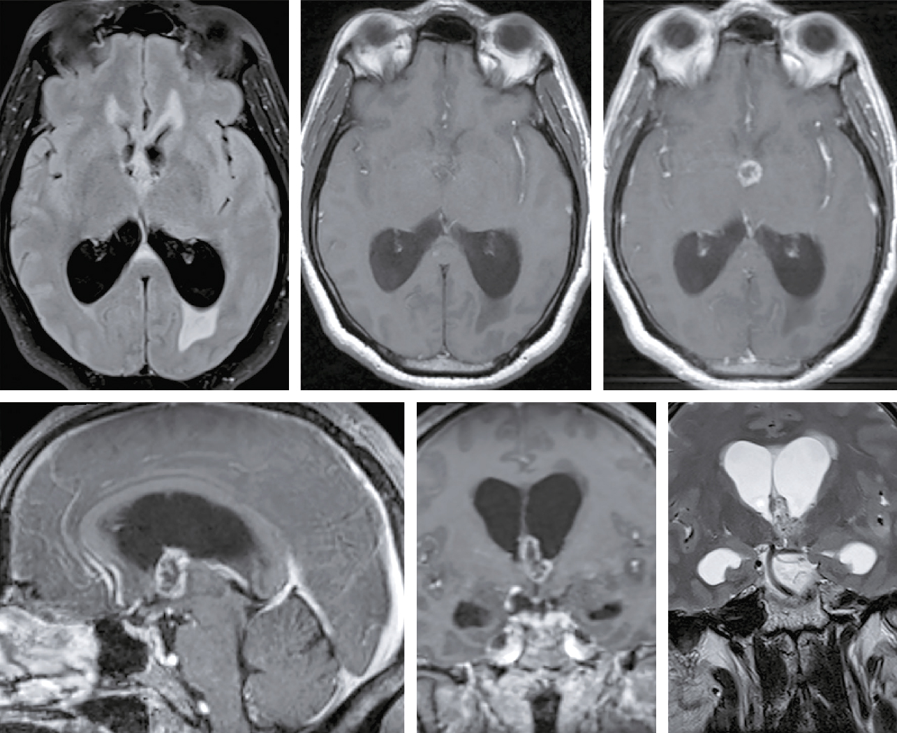 L'image montre des scans IRM avec coupes axiales, sagittales et coronales. Les ventricules, le corps calleux et le cervelet sont visibles, utiles pour détecter des pathologies.