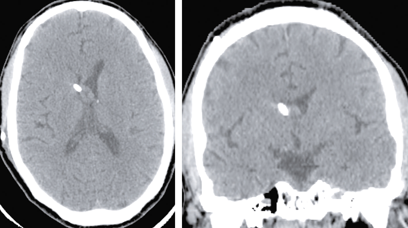 L'image montre deux coupes CT cérébrales : une axiale (horizontale) et une coronale (verticale), illustrant structures internes, ventricules et zones de densités variées.