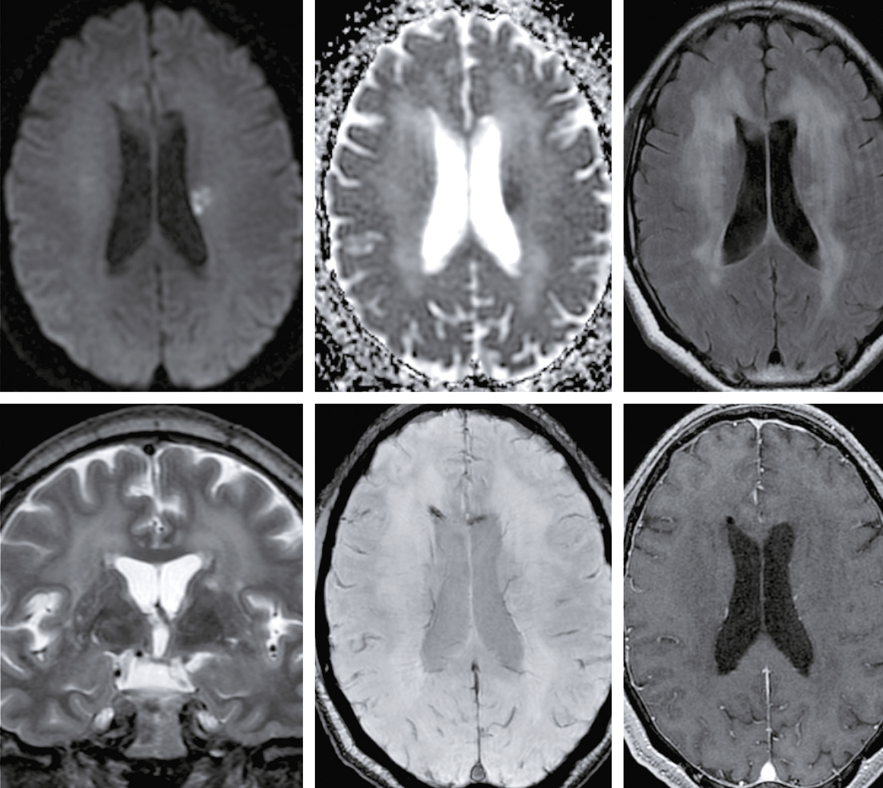 L'image présente six coupes d'IRM cérébrale avec différentes séquences : FLAIR, ADC, T2, SWI et T1 post-contraste, illustrant anomalies et diagnostics précis.