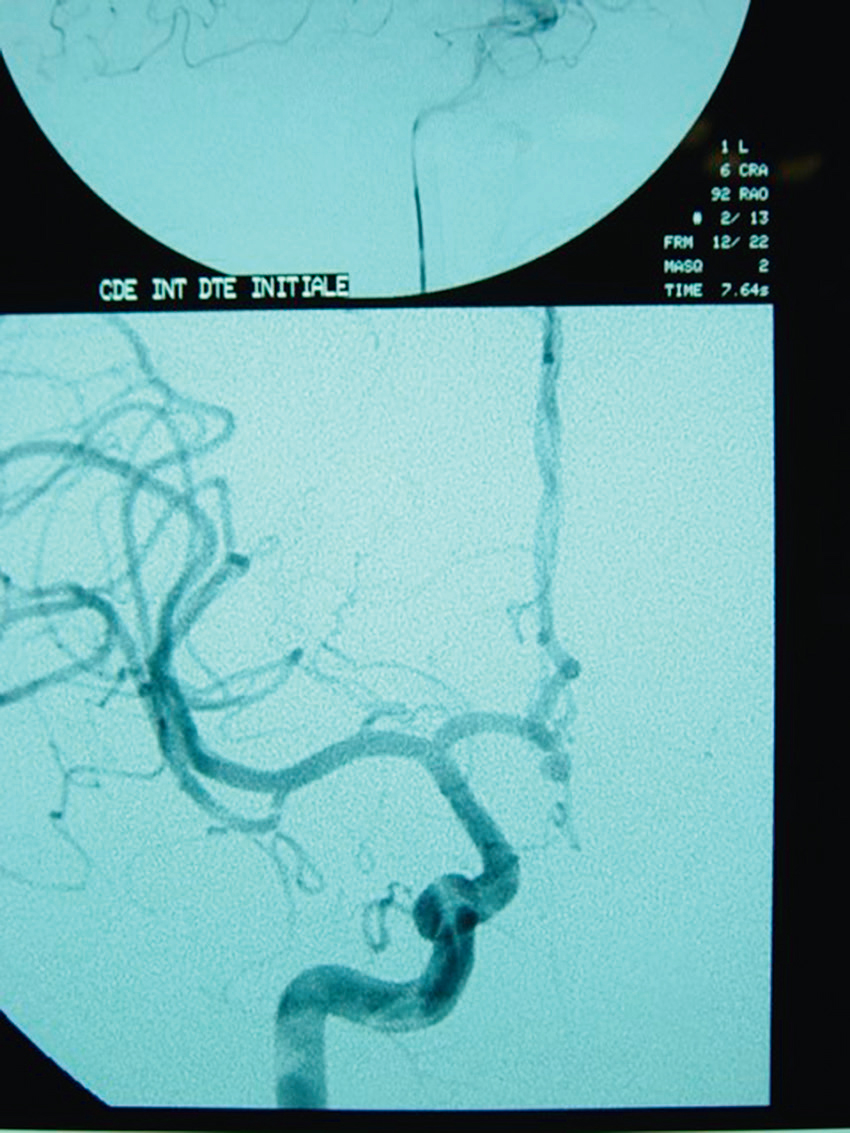 L'image montre une angiographie cérébrale, mettant en évidence les vaisseaux sanguins. Elle détecte des anomalies comme anévrismes, sténoses ou malformations artérioveineuses.