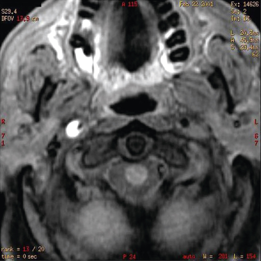 L'image IRM axiale de la tête révèle des structures cérébrales, sinus et cavités nasales. Les paramètres techniques et annotations aident au diagnostic médical précis.