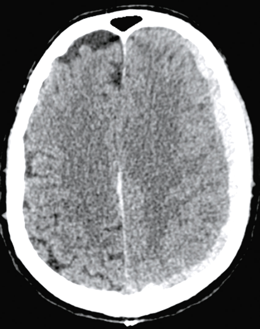 L'image montre une coupe transversale du cerveau avec des détails des ventricules, de la matière grise et blanche, et des os du crâne. Elle permet de détecter des anomalies cérébrales.
