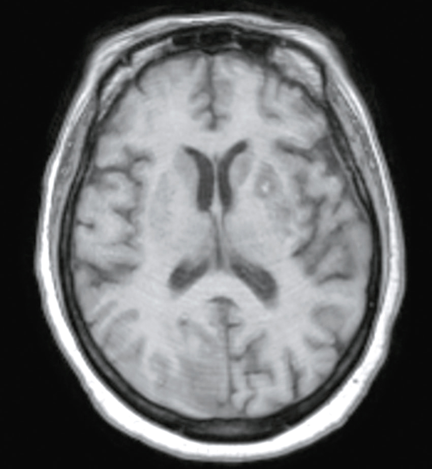 L'image montre une coupe transversale d'IRM du cerveau, mettant en évidence les ventricules latéraux et les zones de matière grise et blanche, utile pour détecter des anomalies neurologiques.