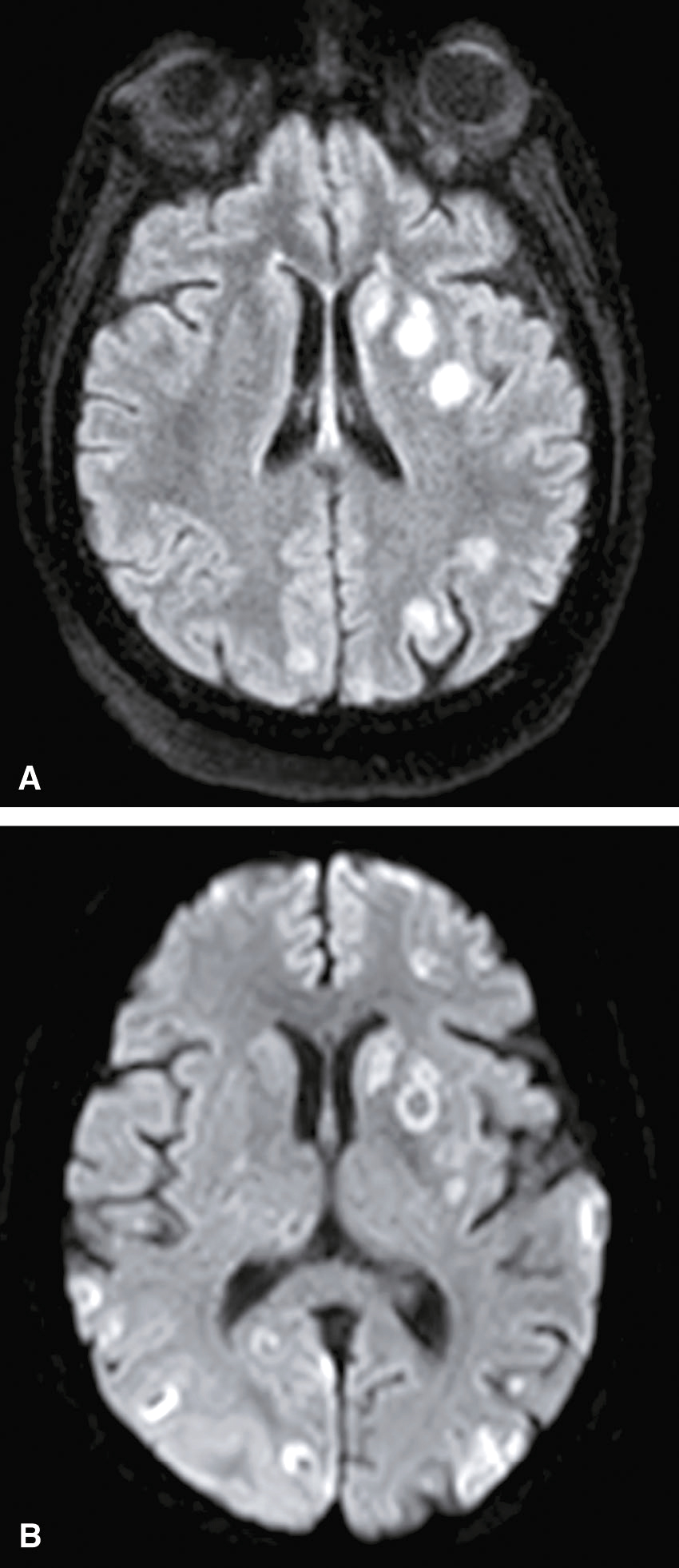 L'image montre une coupe transversale d'IRM du cerveau, avec les ventricules latéraux, la matière grise et blanche. Elle est utilisée pour diagnostiquer des anomalies neurologiques.